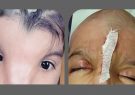 با تلاش پزشکان شیرازی؛ ناهنجاری چهره و جمجمه دختر ۴ ساله درمان شد